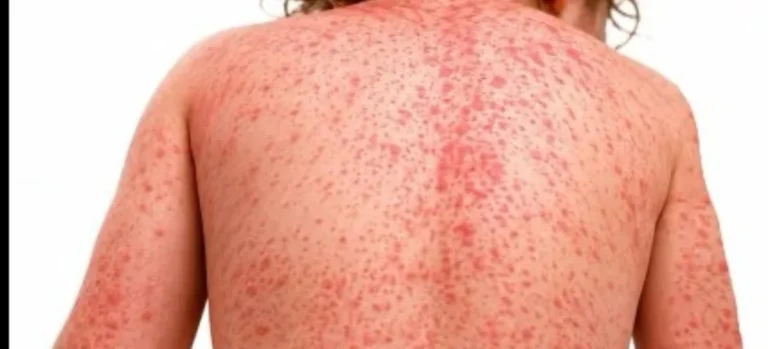 ¡Alerta epidemiológica! San Pedro Sula bajo estricta vigilancia sanitaria por nuevos casos de sarampión